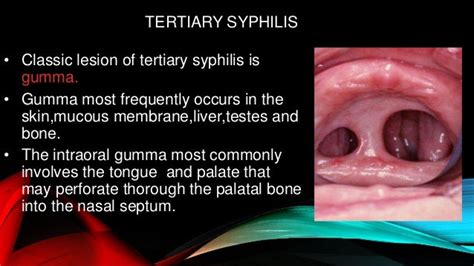 Oral manifestation of syphilis