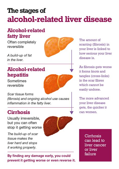 Alcohol-related liver disease (ARLD) - British Liver Trust