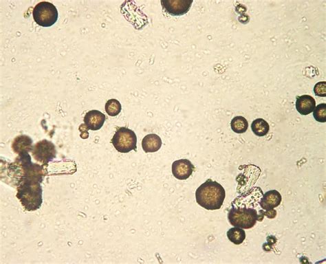 Calcium carbonate crystal | Medical laboratory, Medical laboratory ...