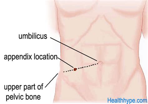 Appendix Pain (Location) and Surgical Removal (Appendectomy) | Healthhype.com