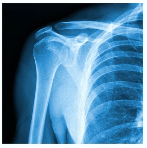 Shoulder-xray-diagnose-injury