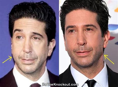 David Schwimmer Plastic Surgery Comparison Photos