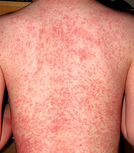 Heat Rash - Pictures, Treatment, Causes, Types, Symptoms, Prevention ...