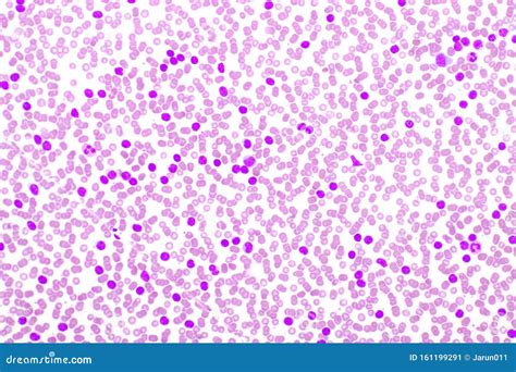 Blood Smear Anemia Patient Show NRBC Medical Science Royalty-Free Stock Image | CartoonDealer ...