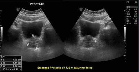 Enlarged Prostate Ultrasound