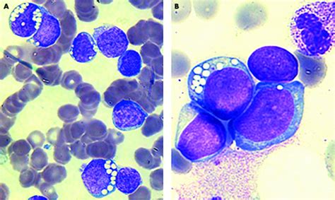 Acute lymphoblastic leukaemia of the L3 subtype in adults in the Northern health region of ...