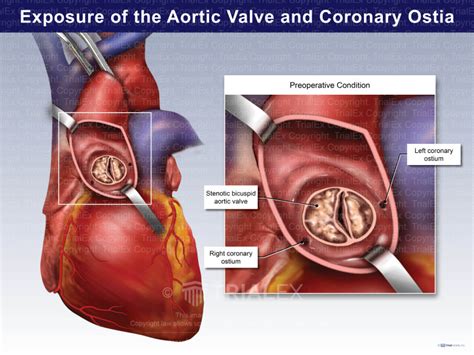 Exposure of the Aortic Valve and Coronary Ostia - TrialQuest Inc.