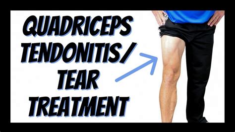 Quadriceps Tendonitis or Tear: Single Best Treatment You Can Do Yourself (Updated) - YouTube