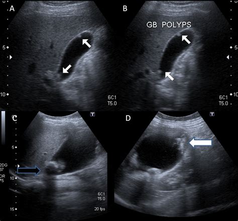 Benign and malignant polyp. (A,B) Ultrasound depicting multiple small ...