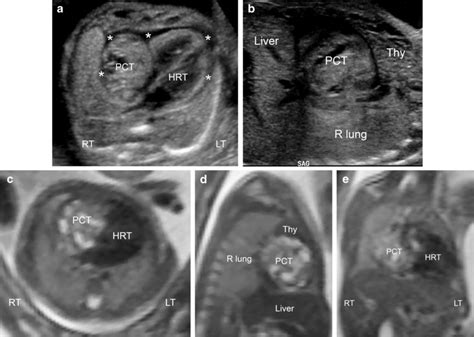 A 22-week fetus with pericardial teratoma. a A transverse gray-scale... | Download Scientific ...