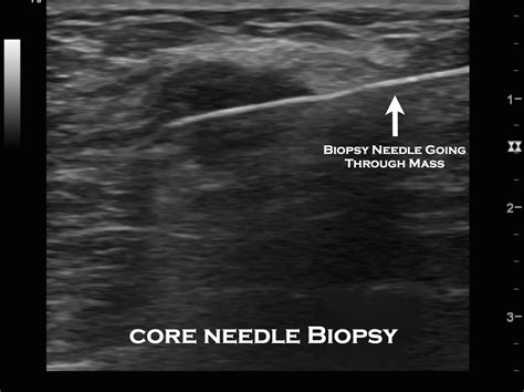 魏銓延 醫師: 乳房粗針切片 Core Biopsy 手術