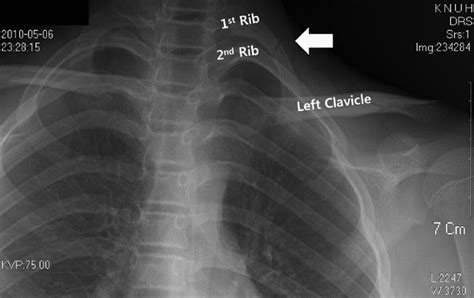 Juvenile First Rib Fracture Caused by Morning Stretching - Journal of Emergency Medicine