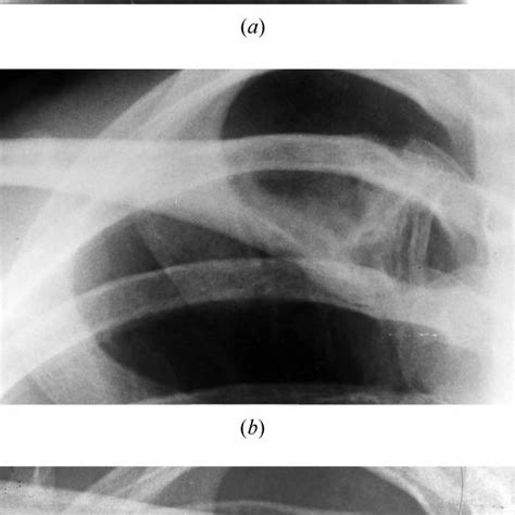 ± (a) Case 2. Radiograph showing bony prominence on the dorsal aspect ...