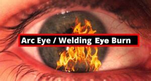 Welding Eyes Burn: Exact Causes and Possible Home Remedies