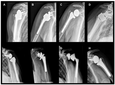 JCM | Free Full-Text | The Evolution of Reverse Total Shoulder ...