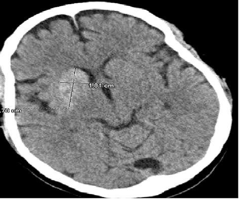 A Rare Case of Hemichorea-Hemiballismus Due to Chronic Uncontrolled ...