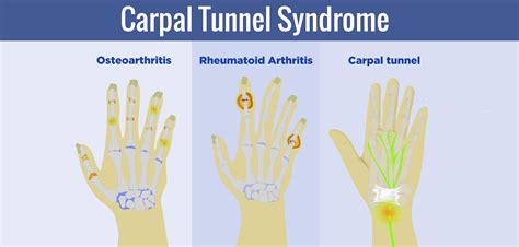 Carpal Tunnel Syndrome Treatment Near Gaithersburg MD
