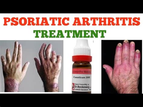 PSORIATIC ARTHRITIS TREATMENT - YouTube