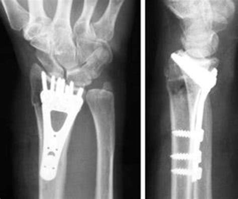 Distal Radius Fractures (Broken Wrist) - OrthoInfo - AAOS