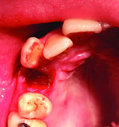 Clot formation inside the tooth socket after laser treatment | Download Scientific Diagram