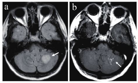 On month 4, MRI demonstrates a new 2-cm lesion in the left cerebellar... | Download Scientific ...