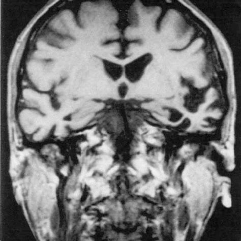 MRI scan for IH, October, 1998 showing severe left temporal lobe ...