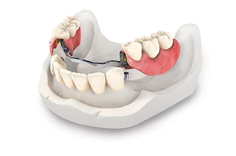 Precision Partial Dentures