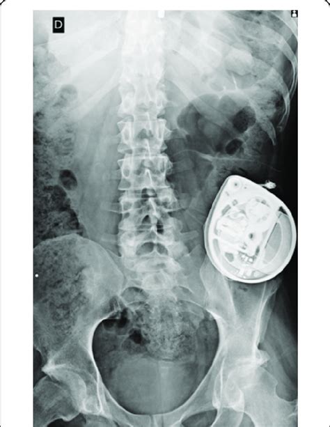 Baclofen pump location in left abdominal side, to avoid interfere in ...