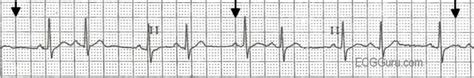 ECG Basics: Sinus Rhythm With Atrial Bigeminy | ECG Guru - Instructor Resources