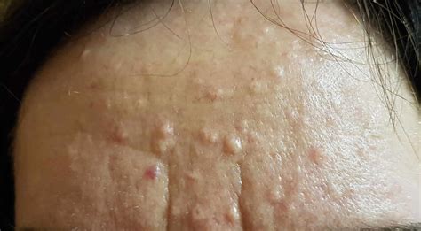 What Are These Small Bumps On My Face?- Sebaceous Hyperplasia By Joanna Koussertari