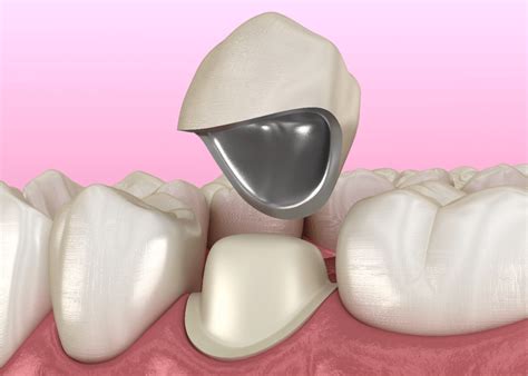 Dental Crown Recementation - Atlas Dental, Toronto dentist