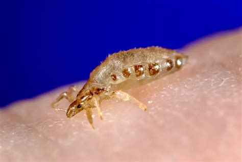 Body Lice | symptoms, diagnosis, treatment, pictures, home remedies