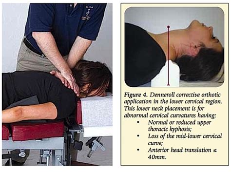 Chiropractic Treatment: Cervical Kyphosis Chiropractic Treatment