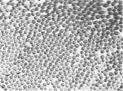 Electron microscopic appearance of the collagen fibrils in the... | Download Scientific Diagram