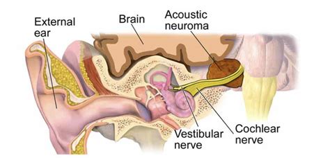 Acoustic Neuroma - Brain Balanz