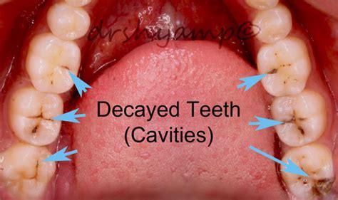 Restoration of decayed tooth - Vignesh Dental Speciality Center