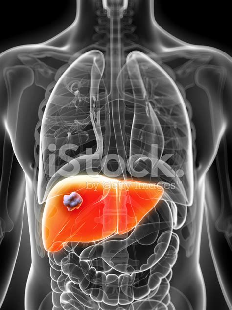 Liver Cancer Stock Photo | Royalty-Free | FreeImages