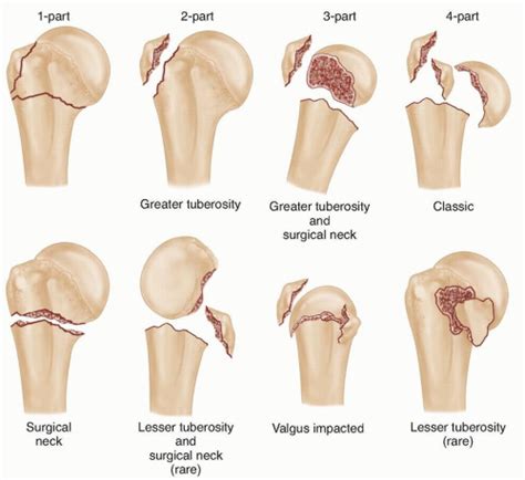 Open Reduction and Internal Fixation of Proximal Humerus Fractures | Musculoskeletal Key