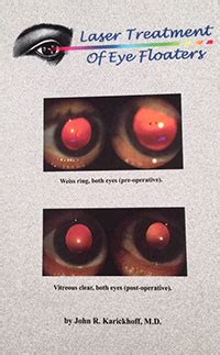 Our Book - Laser Treatment of Eye Floaters - Laser Treatment of Eye Floaters