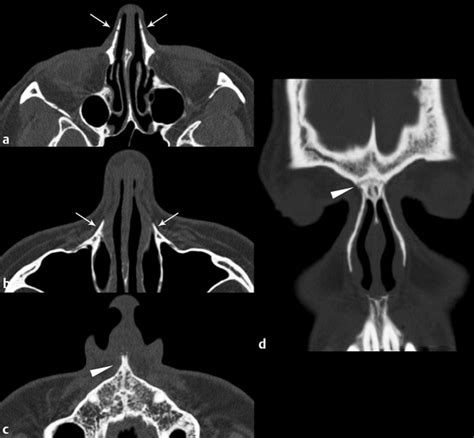 Nasal Bone Xray