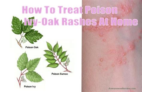 15 Reliable Home Remedies to Get Rid of Poison Ivy–Oak–Sumac Rashes