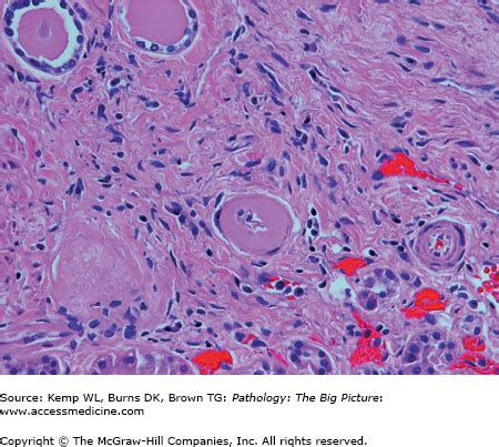 Vascular Pathology | Basicmedical Key