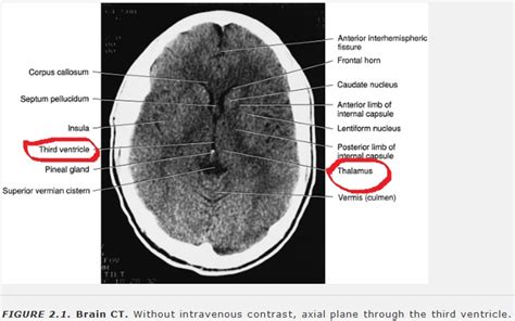 (DOCX) Anatomi Ct Scan Kepala - PDFSLIDE.NET