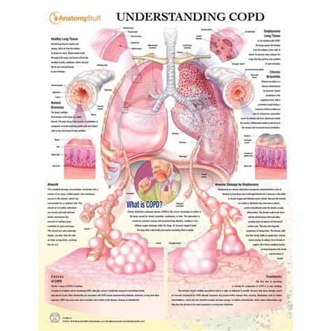 Understanding COPD Chart Poster Laminated COPD10 | Lung anatomy, Copd, Respiratory system