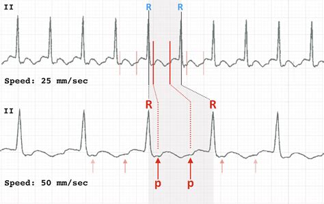 ECG Rate Interpretation • LITFL Medical Blog • ECG Library Basics