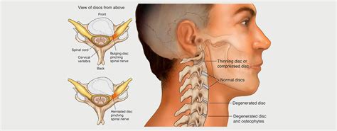 CERVICAL HERNIATED DISC - MOTUS Physical Therapy