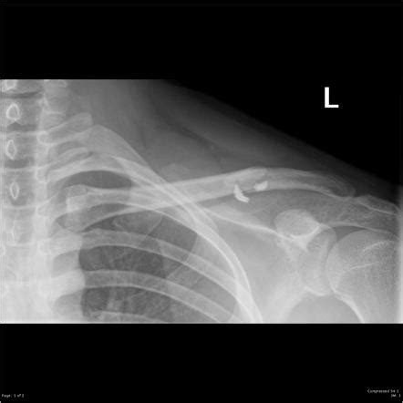 Clavicle Fracture Wikipedia