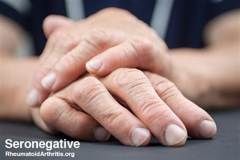 Seronegative RA: What are the Symptoms of Seronegative RA? - RheumatoidArthritis.org