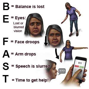 Right Sided Stroke Symptoms