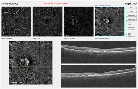 OCT angiography & ARMD